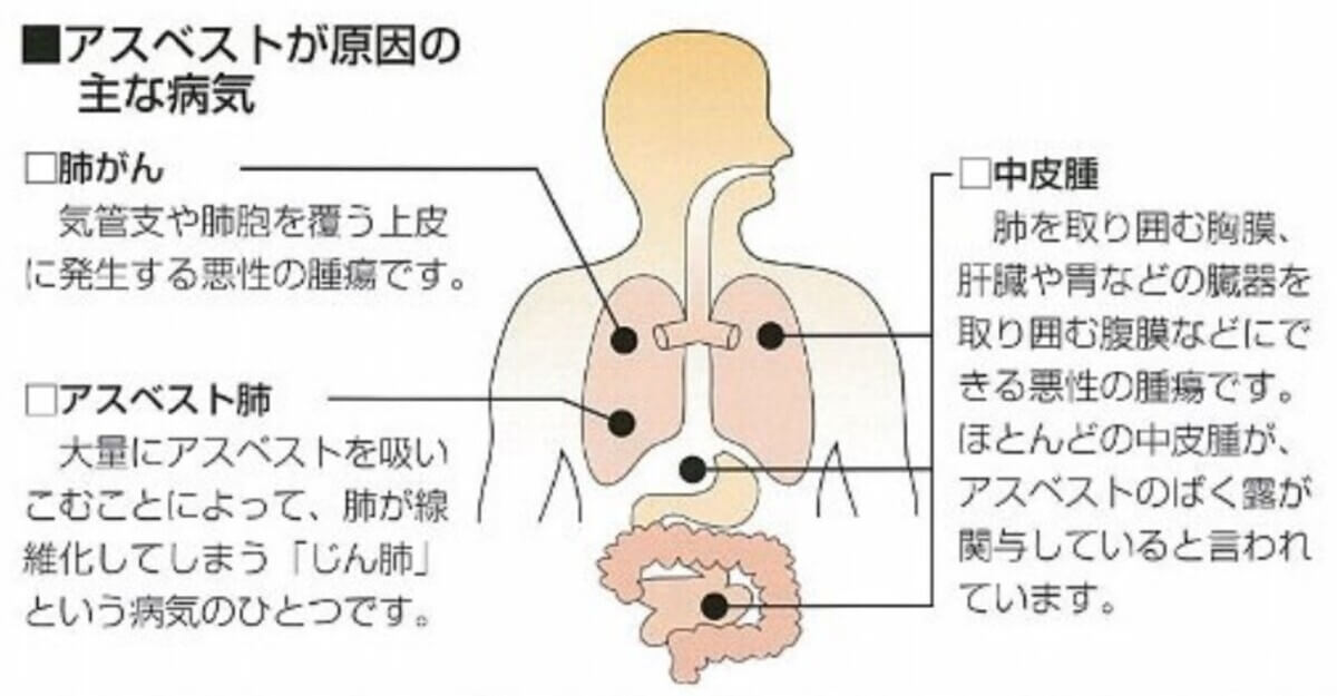アスベストによって引き起こされる3つの病気