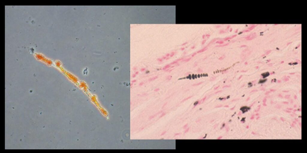 アスベスト小体